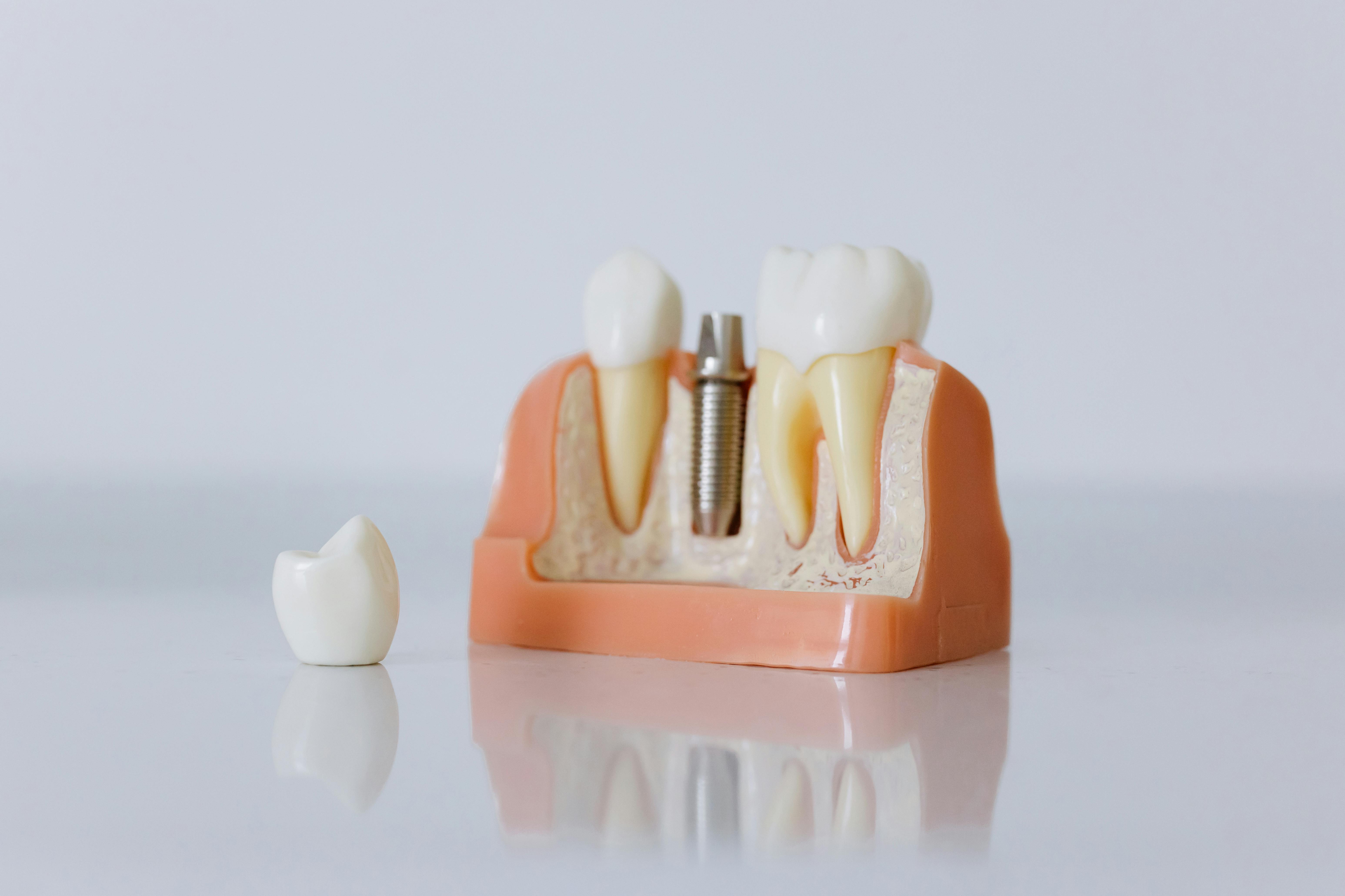 Implantes y coronas dentales - DentalCare